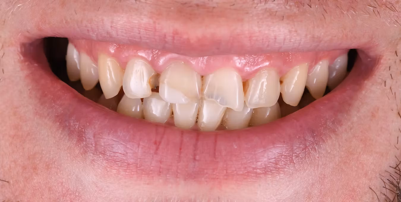 Broken teeth image