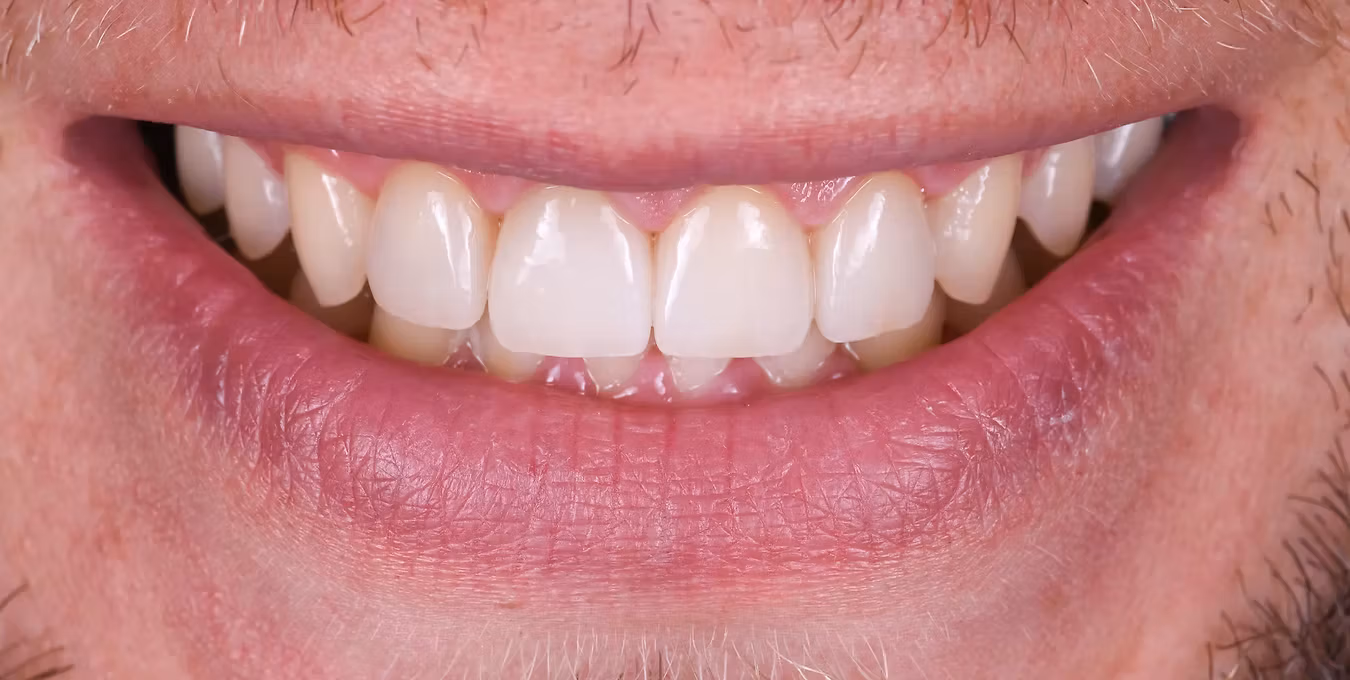 Straightened teeth image